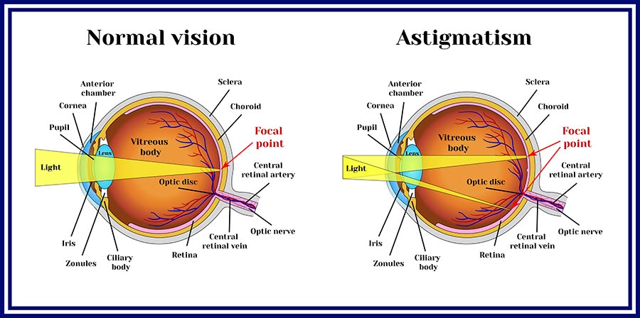 Astigmatism care is available at CEENTA