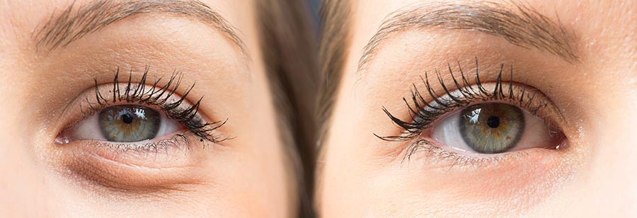 Example of Eyelid Surgery, Blepharoplasty procedure in Charlotte, and eye lift surgery at CEENTA