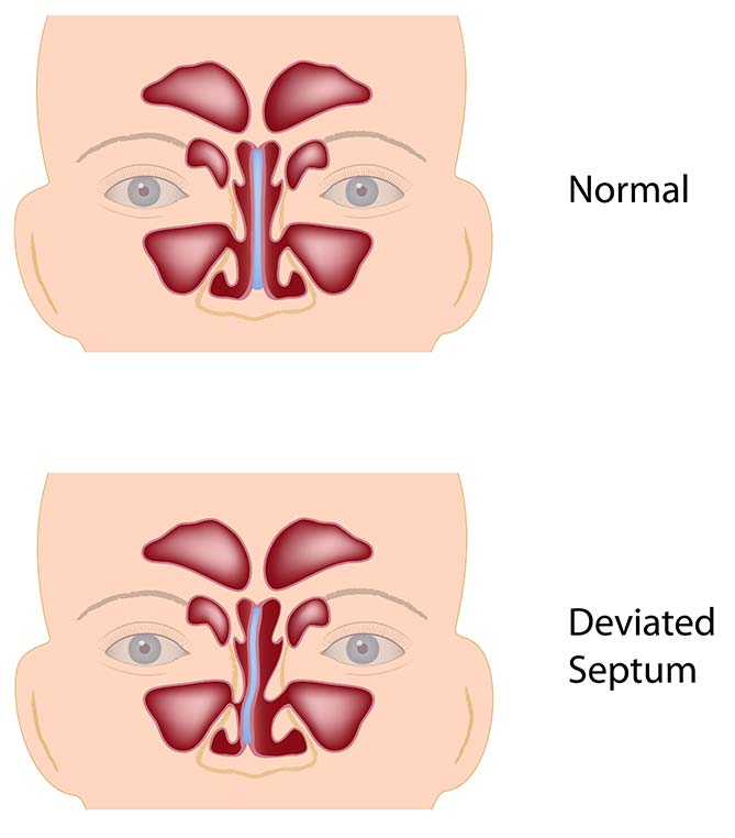 Image of deviated septum that can be treated with a septoplasty and surgery for a deviated septum