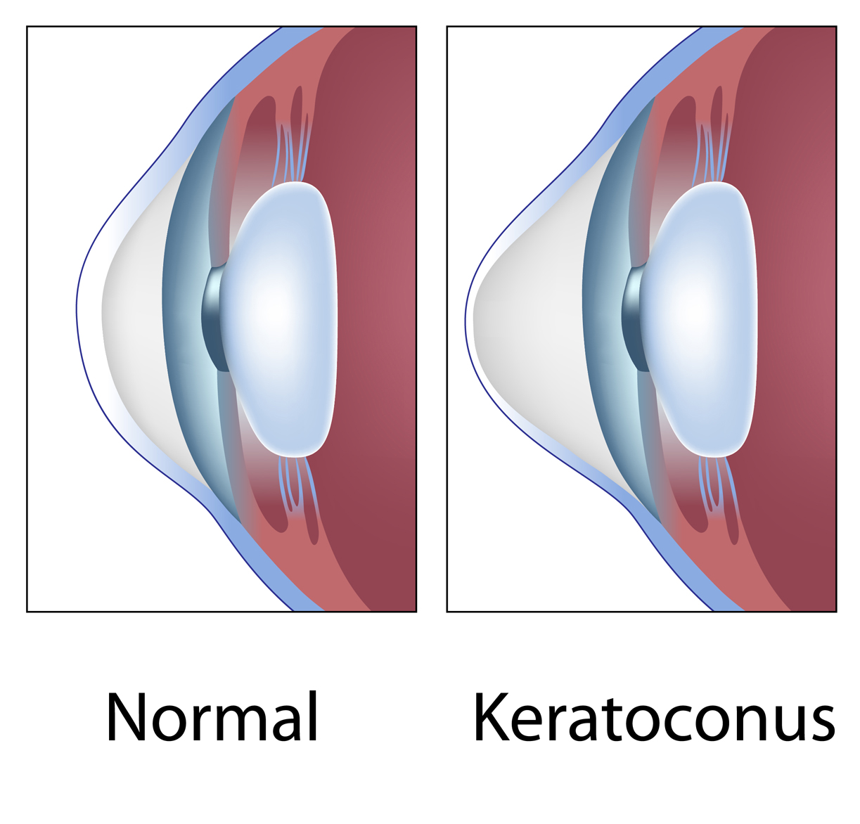 The shape of the cornea in a patient with keratoconus, corneal cross-linking