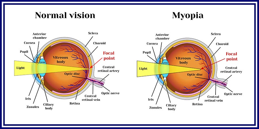 Myopia care is available at CEENTA