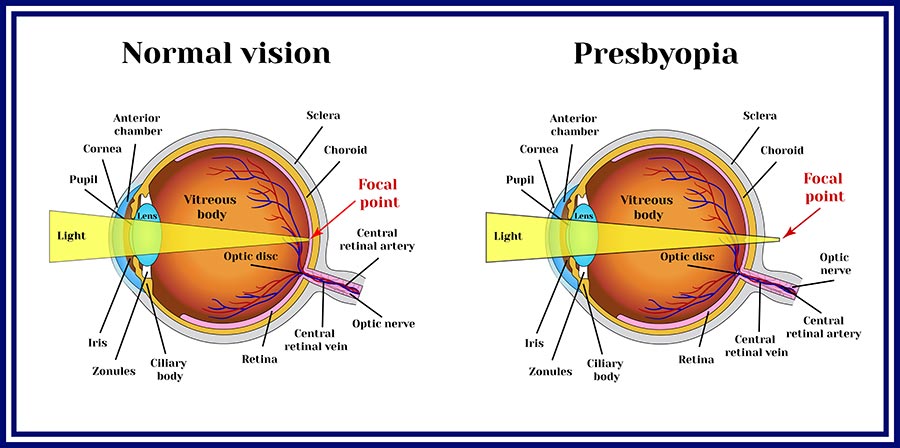 Presbyopia care is available at CEENTA