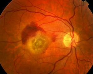 Wet Age-Related Macular Degeneration care is available at CEENTA