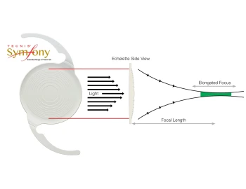 symfony lens is a new design for cataracts