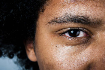 The eye of someone with glaucoma that was caused by shingles