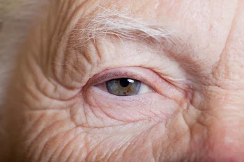 An older person with arthritis that affects their eyes.