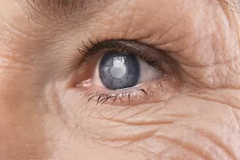 Woman with cataracts who may have her hobbies and life affected