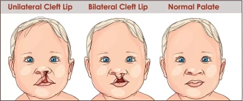 A diagram of a cleft lip and cleft palate