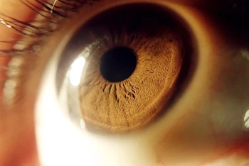 A cornea that received a transplant.