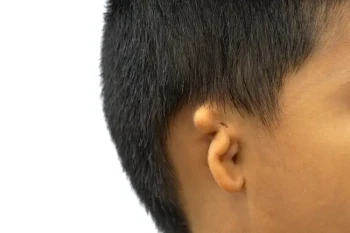 Child with microtia who is a candidate for pediatric ear reconstruction