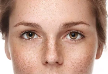 A woman with eye freckles