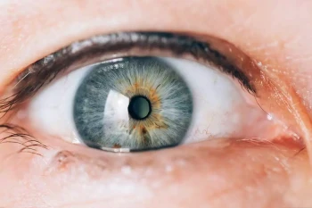An eye with an implantable contact lens