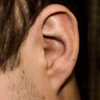 A man's ear after an otoplasty