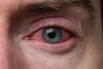 Someone with COVID and conjunctivitis