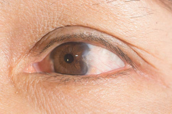 Pterygium