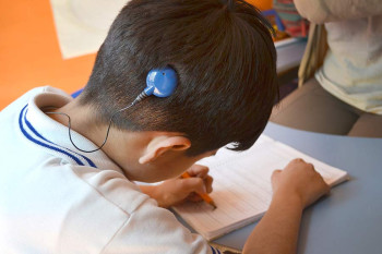 A single-sided cochlear implant