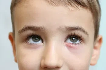 Styes in children can be red, painful bumps