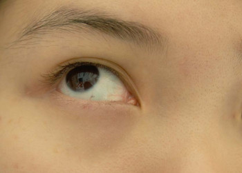 A twitching eye