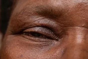 Man with drooping eyelid or ptosis