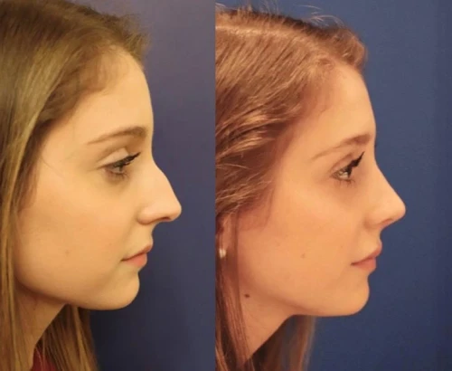 Facial Plastic Surgery  Facial Plastics in Charlotte