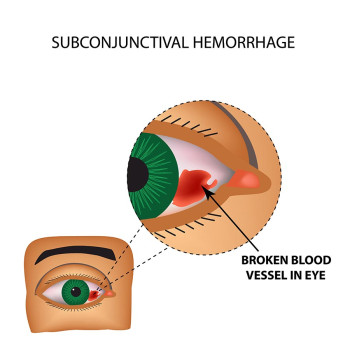 blood vessel burst in eye blood vessel burst in eye