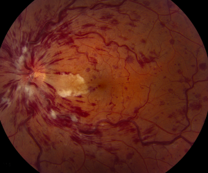 Retinal Vein Occlusion