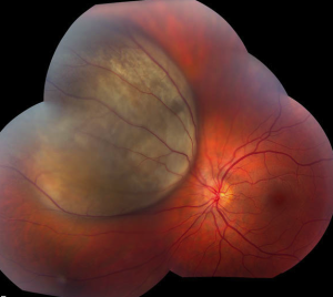 Ocular Tumors