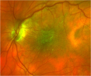 Epiretinal Membrane