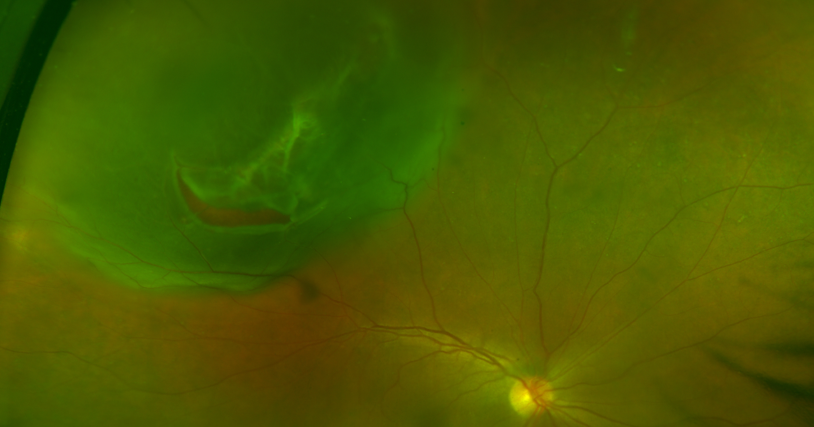 Photo of an eye with a retinal detachment with a retinal tear