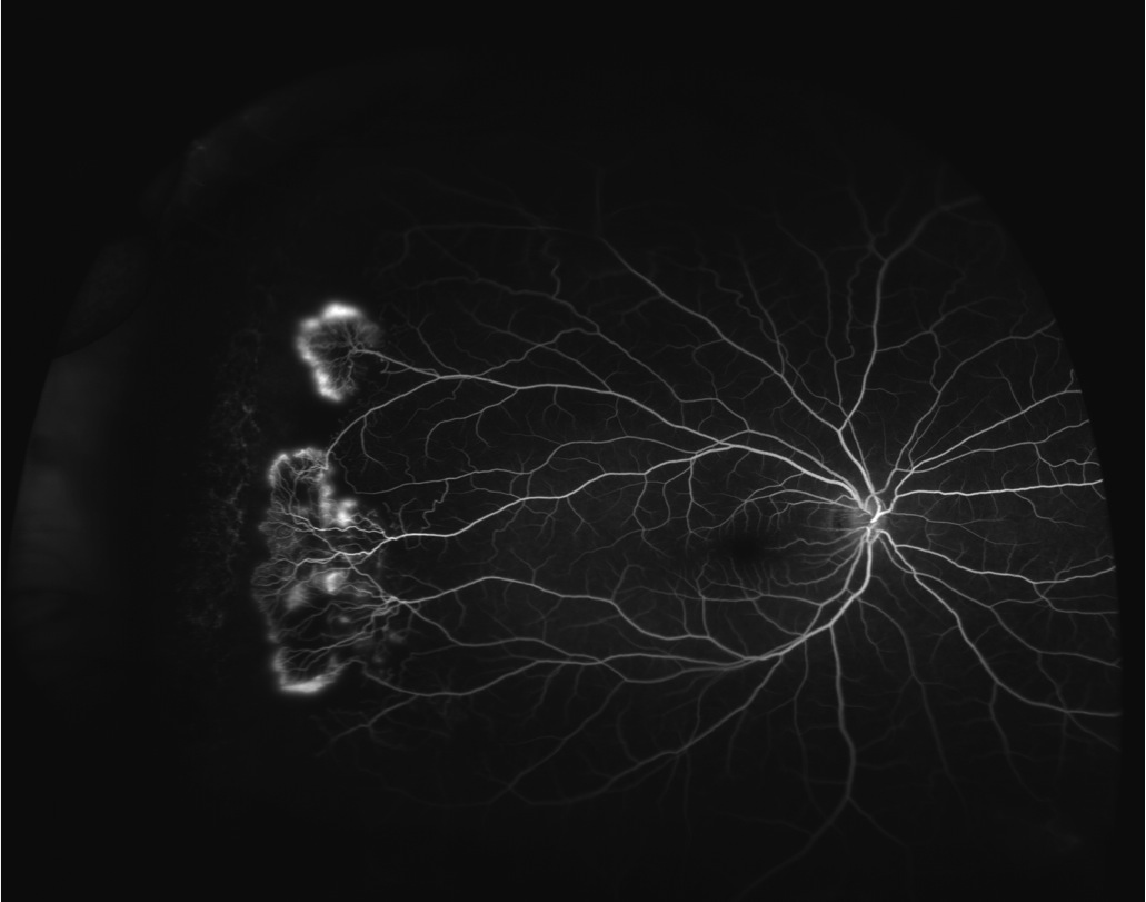 sickle cell anemia with retinopahty