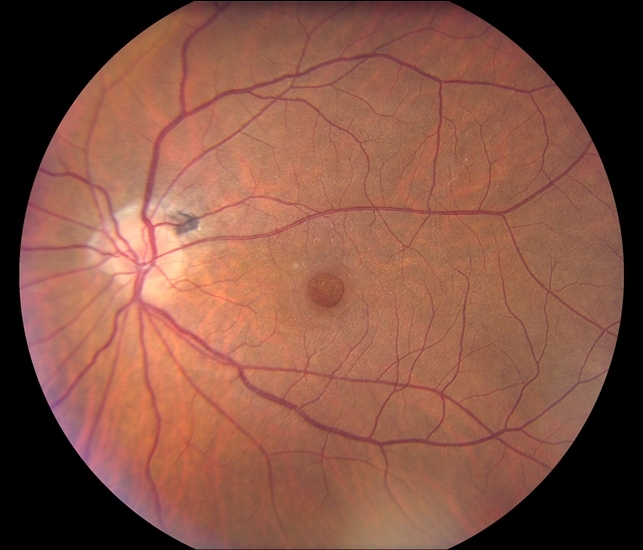 Macular Hole