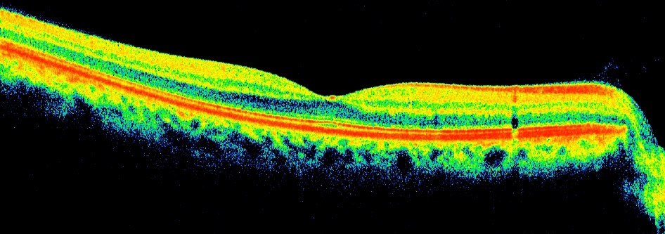 Normal Retina OCT