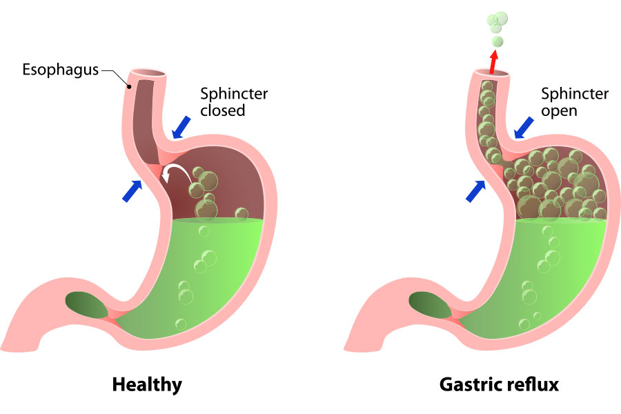 Acid reflux