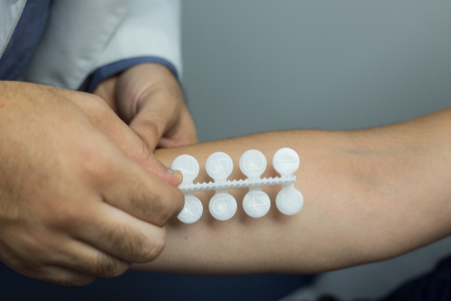 Allergy test on the skin to test for allergens