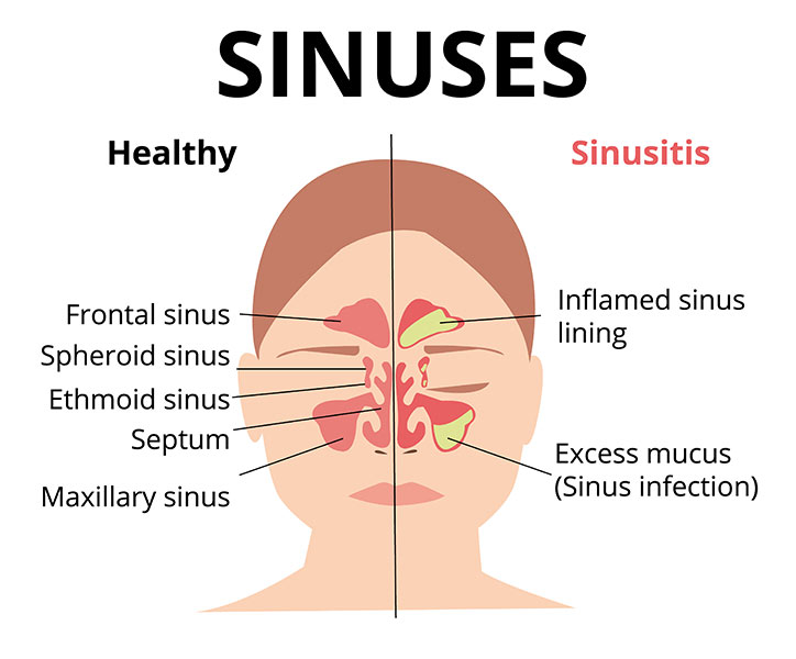 Chronic sinusitis, sinusitis chart showing symptoms of sinus infection