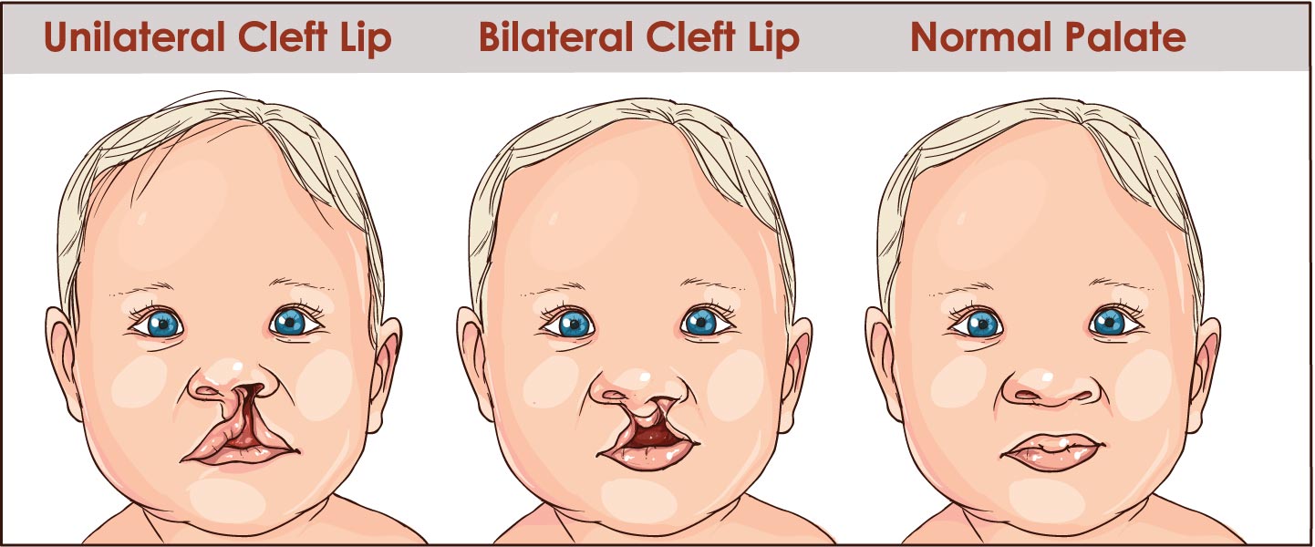 Pictures of a cleft lip and a normal palate. Some patients also have a cleft palate