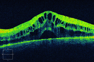 Cystoid Macular Edema