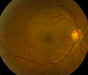 Central Serous Retinopathy 