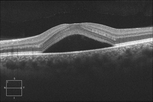 Central Serous Retinopathy OCT