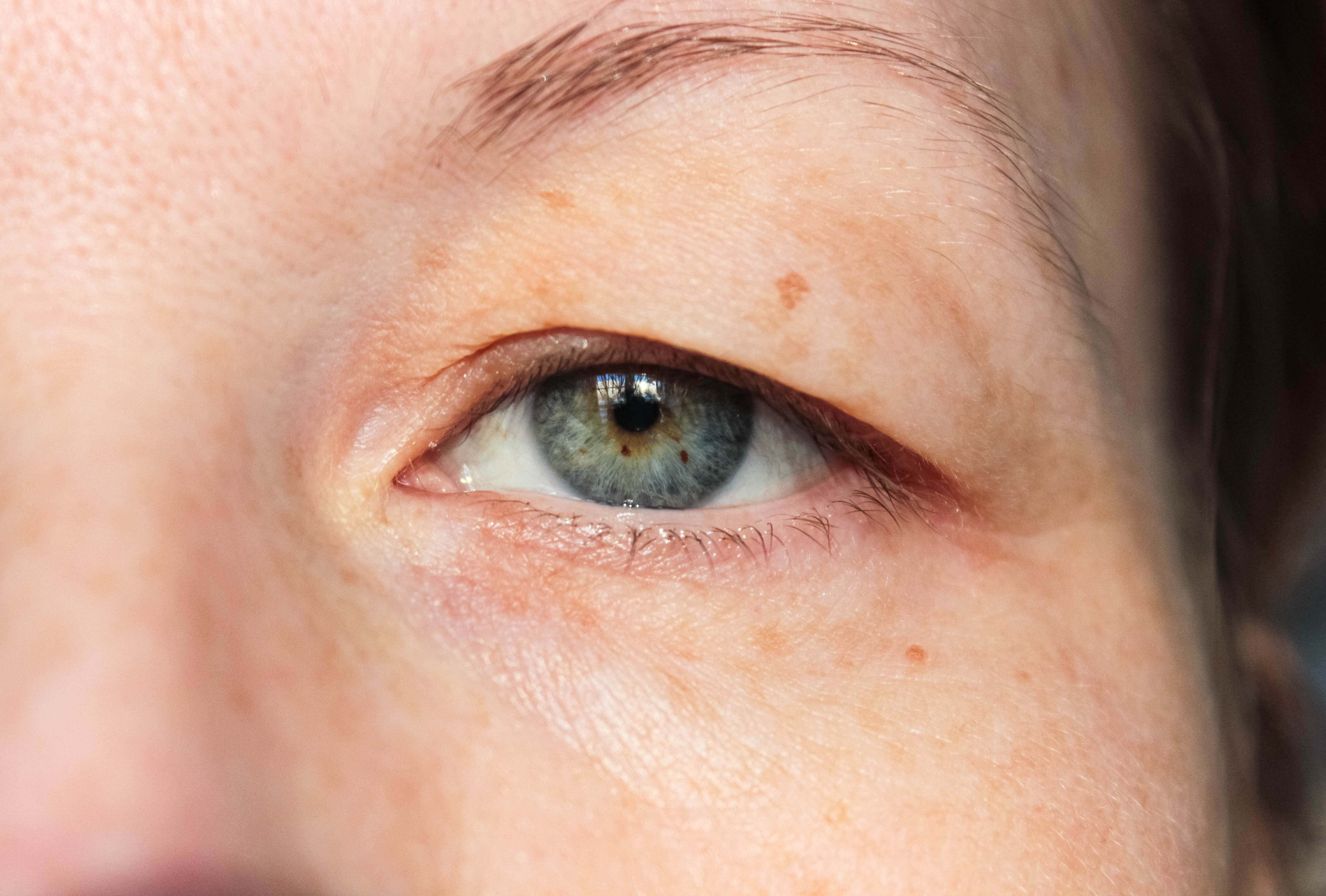 Drooping eyelid and ptosis, and eyelid drooping treatment