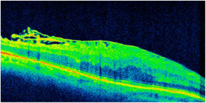 Epiretinal Membrane OCT