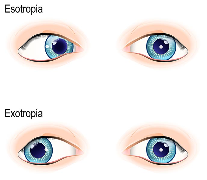 Strabismus, esotropia and exotropia are all examples of crossed eyes and eye misalignment