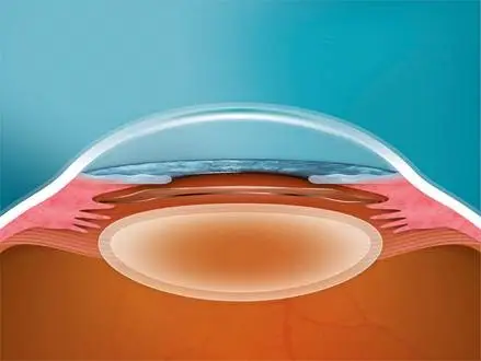 Visual of implantable collamer lens