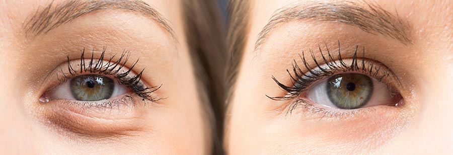Example of lower eyelid blepharoplasty eyelid procedure
