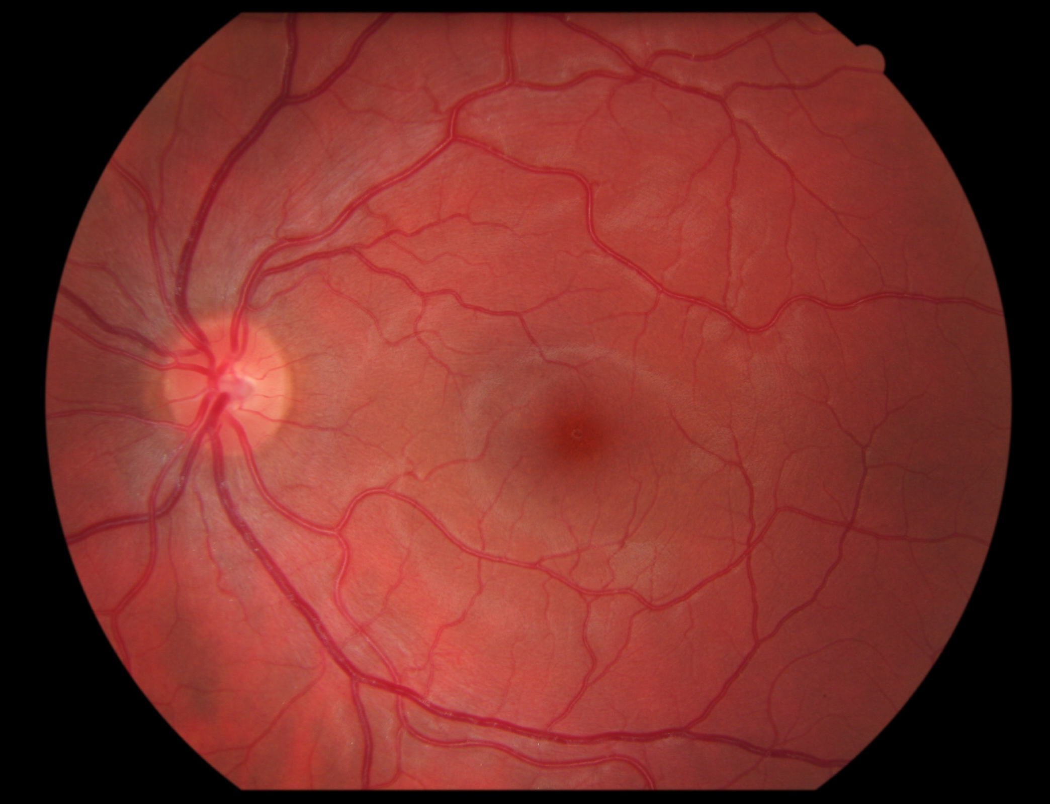 Retinal diseases - The American Society of Retina Specialists