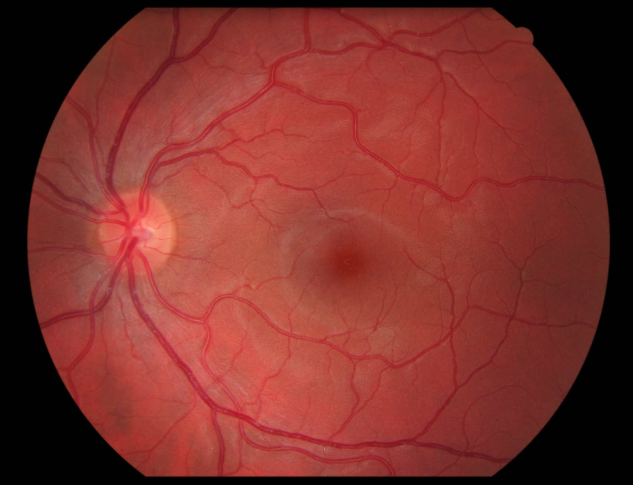 Normal Retina