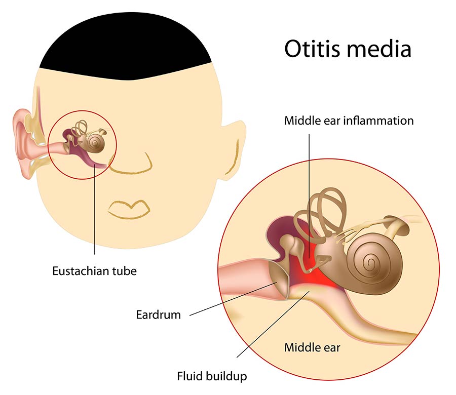 Otitis media/ear infections can be treated with ear tubes