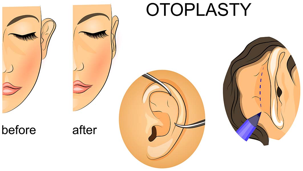 Otoplasty procedure