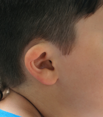 Pediatric ear deformity that can be corrected with neonatal ear molding