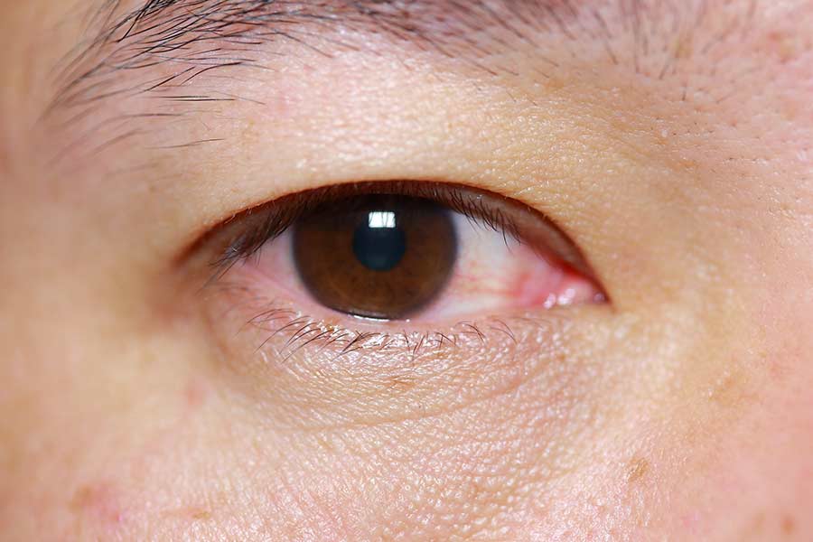 Pink eye, conjunctivitis, eye infection, eye infection symptoms